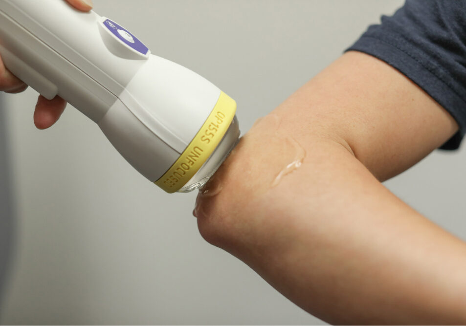SoftWave Elbow Treatment