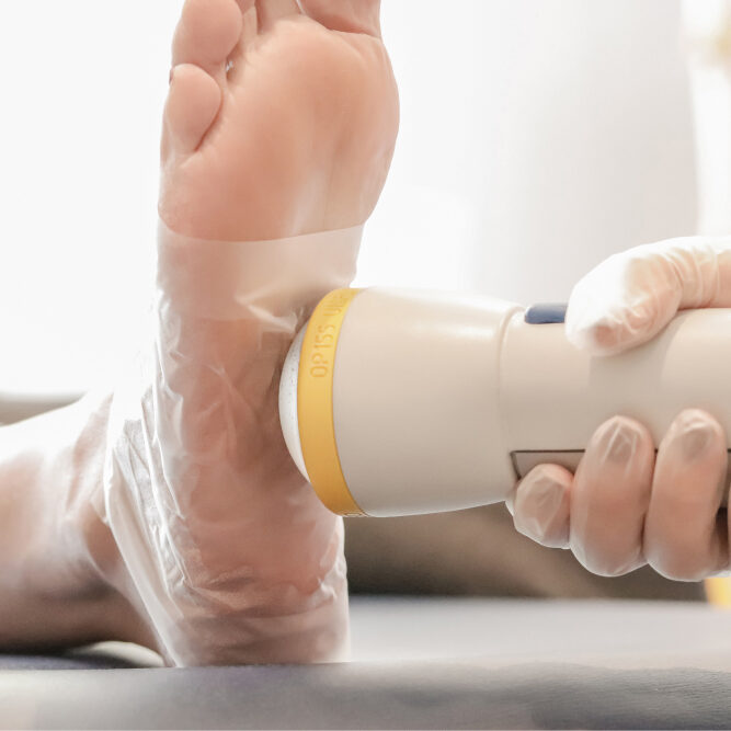 SoftWave Foot Treatment